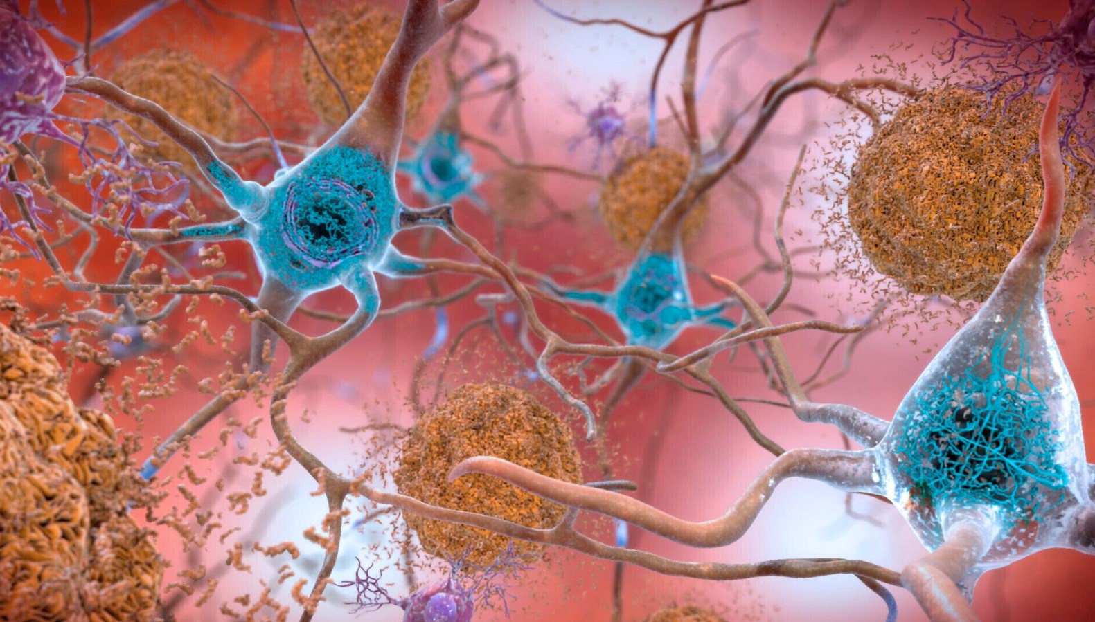 Yapılan yeni bir araştırmaya nazaran, iki kanser ilacı Alzheimer hastalığının