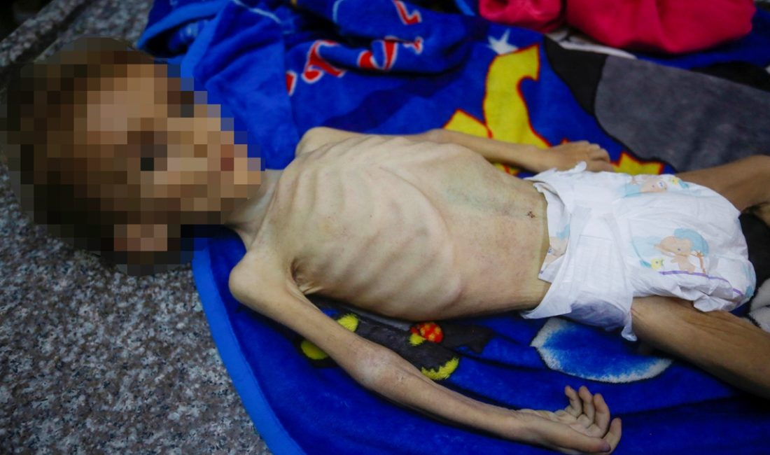 İsrail'in ablukaya aldığı Gazze'nin Deyr Belah kentinde, yetersiz beslenme nedeniye