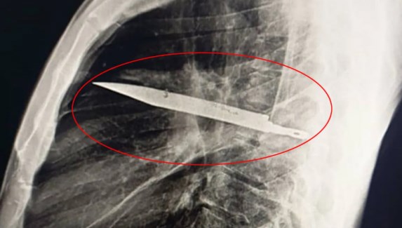 Tanzanya'da ağrı şikayetiyle hastaneye başvuran adamın, 8 yıldır göğsünde bir