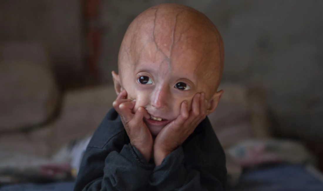 Progeria, çocuklarda olağan dışı süratte yaşlanmaya yol açan, son derece