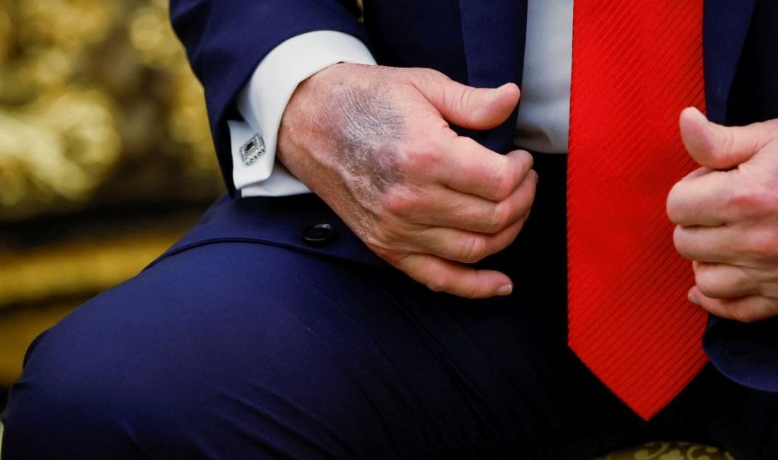 Trump'ın Oval Ofis’te düzenlediği basın toplantısında sağ elinin üzerinde koyu