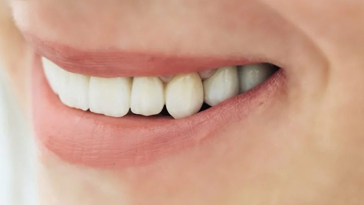 Dişlerde oluşan renk değişimleri çoğu kişi için estetik açıdan olumsuz
