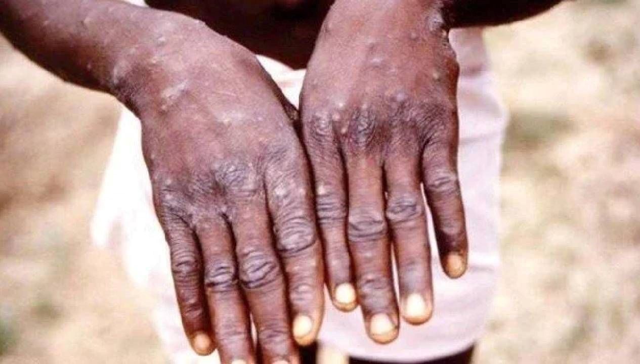 Afrika ülkesi Namibya'da ilk M çiçeği (mpox) vakasının tespit edildiği