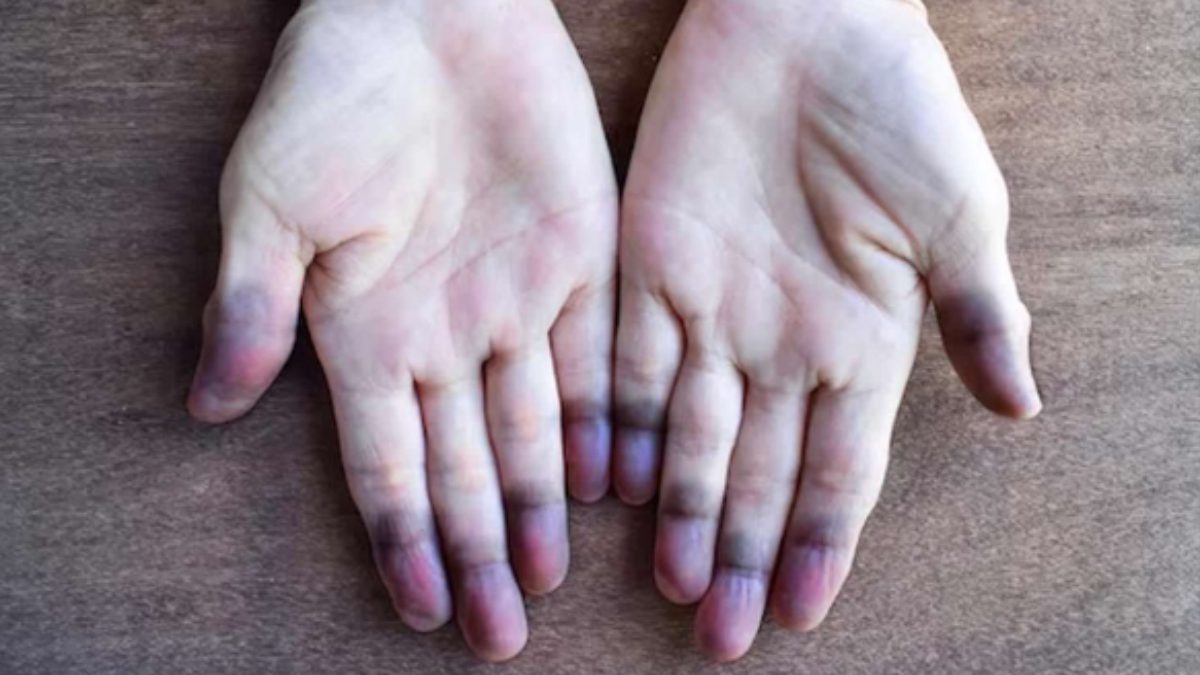 Sigara kullanımı, bazı kişilerde el ve ayaklardaki küçük damarların ağır