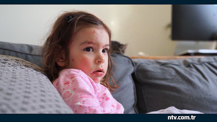 Türkiye’de uzun zaman önce neredeyse tamamen ortadan kaldırılmış bazı hastalıklar,