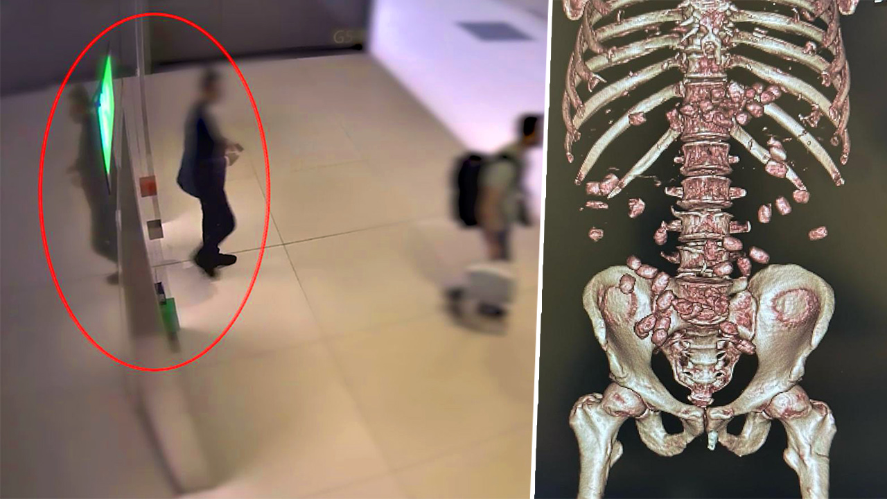 İstanbul Havalimanı'nda yürümekte zorlanan bir yolcunun midesinden 26 kapsül içerisine