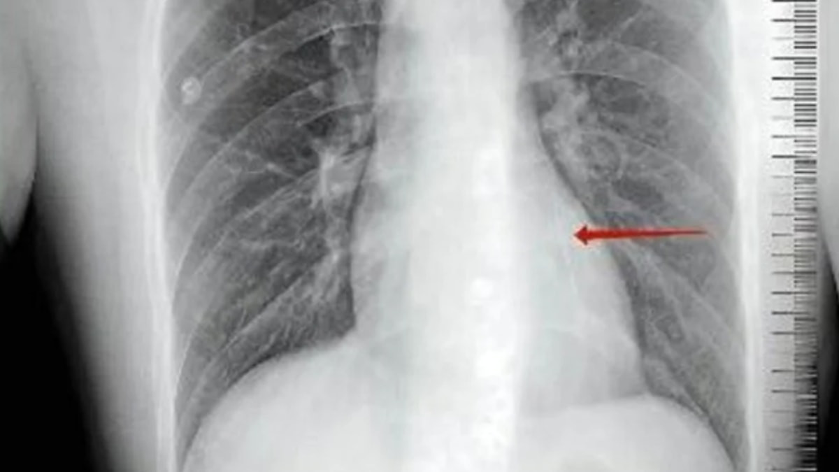 ScienceAlert'in haberine göre Çin'de hastaneye idrarında kan şikayetiyle başvuran 35